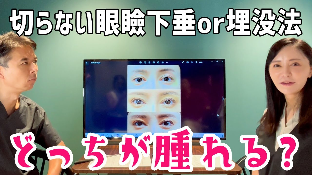 【二重埋没法】切らない眼瞼下垂とどっちが腫れるか検証してみた【週末うめこ】