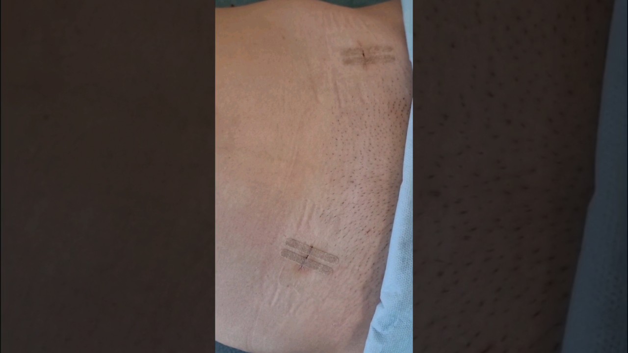 Вид живота через сутки после лапароскопии 👌