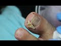 Ep_3336 Big ingrown toenail removal 👣 เธอจ๋า..ลืมตาได้ 😷 (clip from Thailand)