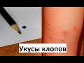 Как выглядят укусы клопов