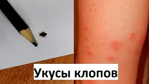 Как выглядят укусы клопов