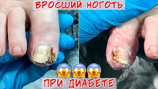 Ingrown toenail in diabetes and oncology / The surgeon did not help 😖