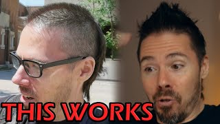 Reverse Male Pattern Baldness in 5 STEPS (Before and After)