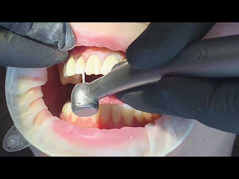 Veneer preps