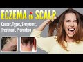 Eczema on Scalp Causes, Types, Symptoms, Treatment and Prevention | Scalp Dermatitis dandruff