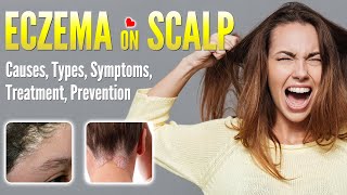 Eczema on Scalp Causes, Types, Symptoms, Treatment and Prevention | Scalp Dermatitis dandruff