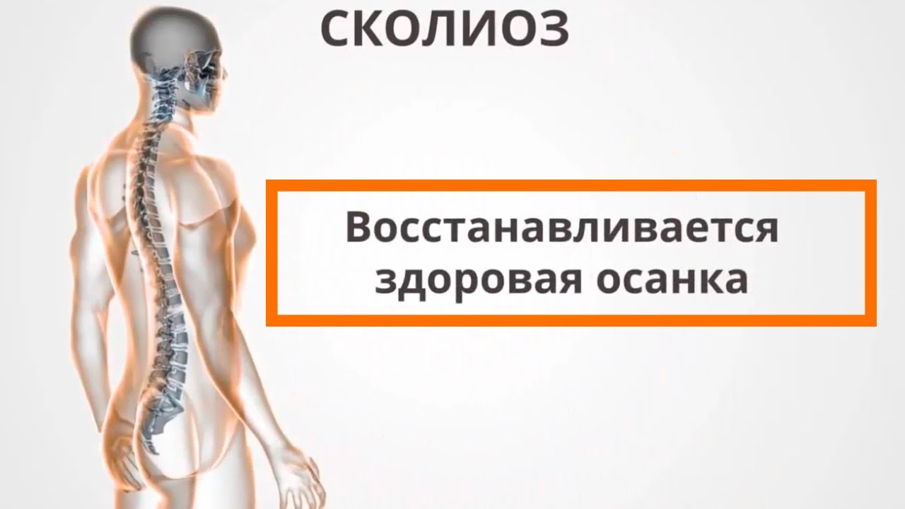 Профилактика сколиоза. Лечение искривления позвоночника без операции: доступно и проверено.