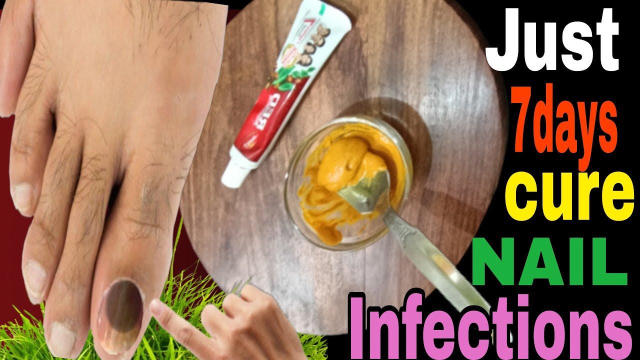 Best Home Remedy For Toenail Fungus Cure Just in 7 days - nail