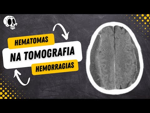 How to Differentiate HEMATOMAS and HEMORRHAGES on a CT Scan | EPIDURAL, SUBDURAL, SUBARACHNOID