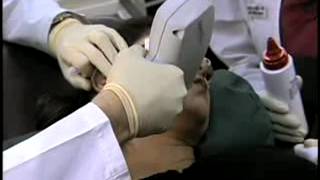 Discovery Channel Dr Berman Laser Hair Removal