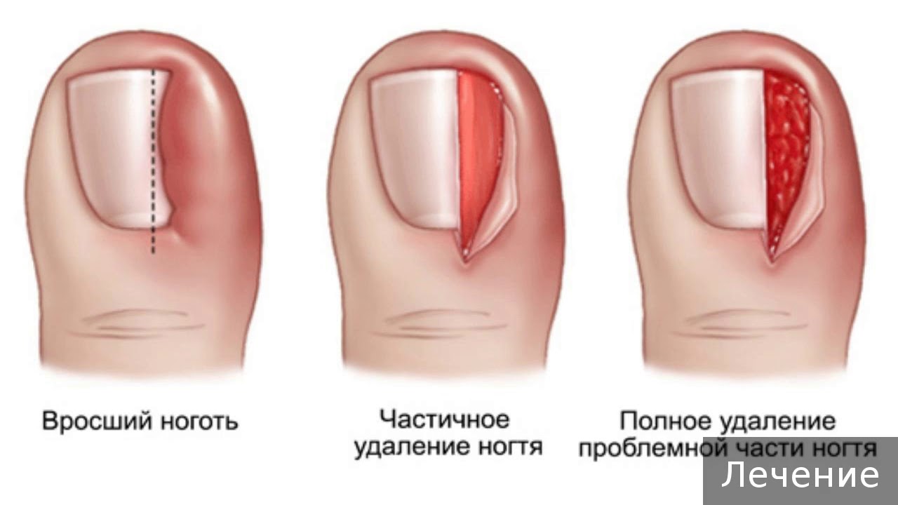 Ноготь в рос что делать. Онихокриптоз вросший ноготь. Вросший ноготь анатомия. Онихокриптоз операция. Вросший ноготь операция Шмидена.