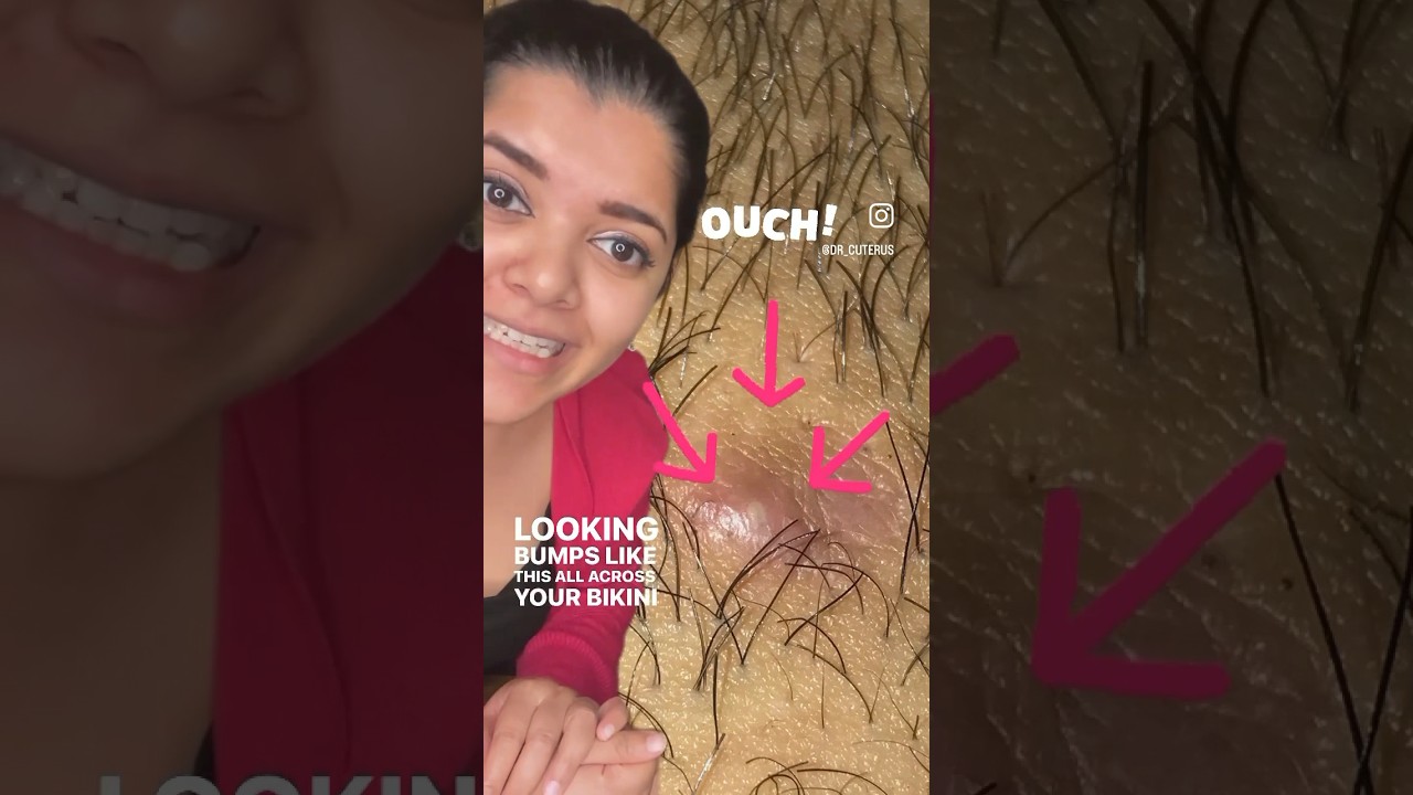 Прыщи после бритья? Доктор Кутерус объясняет