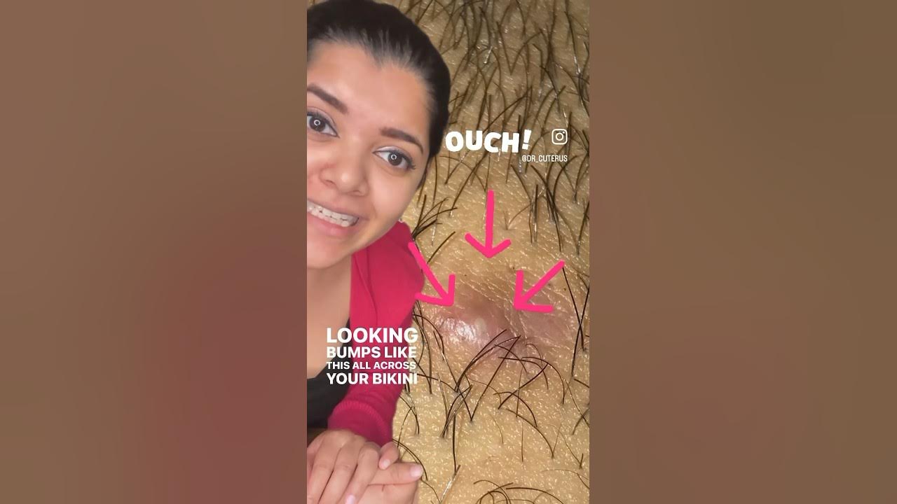 Pimples after shaving? DrCuterus explains YouTube