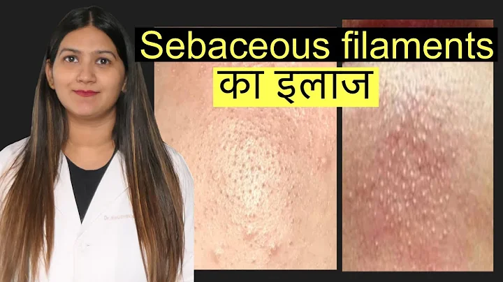 Sebaceous filaments( pores on nose) treatment in Hindi | नाक पर दिखने वाले पोर का इलाज | - DayDayNews
