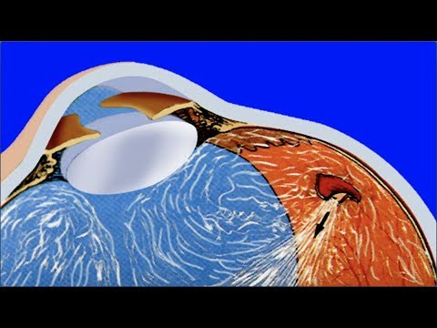 Vidéo: Gonflement Du Disque Optique Dans La Rétine Des Chiens