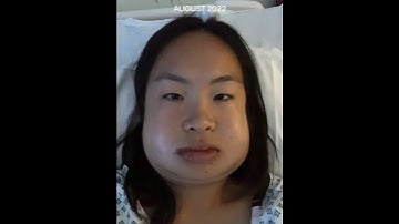 JAW SURGERY PROGRESS | 9 MONTHS LATER