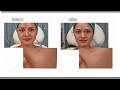 OILY SKIN AND SKIN PORE REDUCTION USING BOTULINUM TOXIN