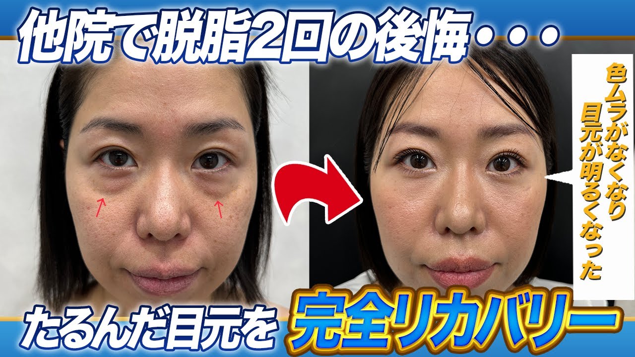 【クマ取り】「2度の脱脂施術からついに理想の肌へ！色ムラ解消で若返り成功✨