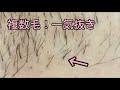 【複数毛】１つの毛穴から３本。一気抜き