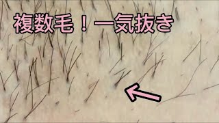 【複数毛】１つの毛穴から３本。一気抜き