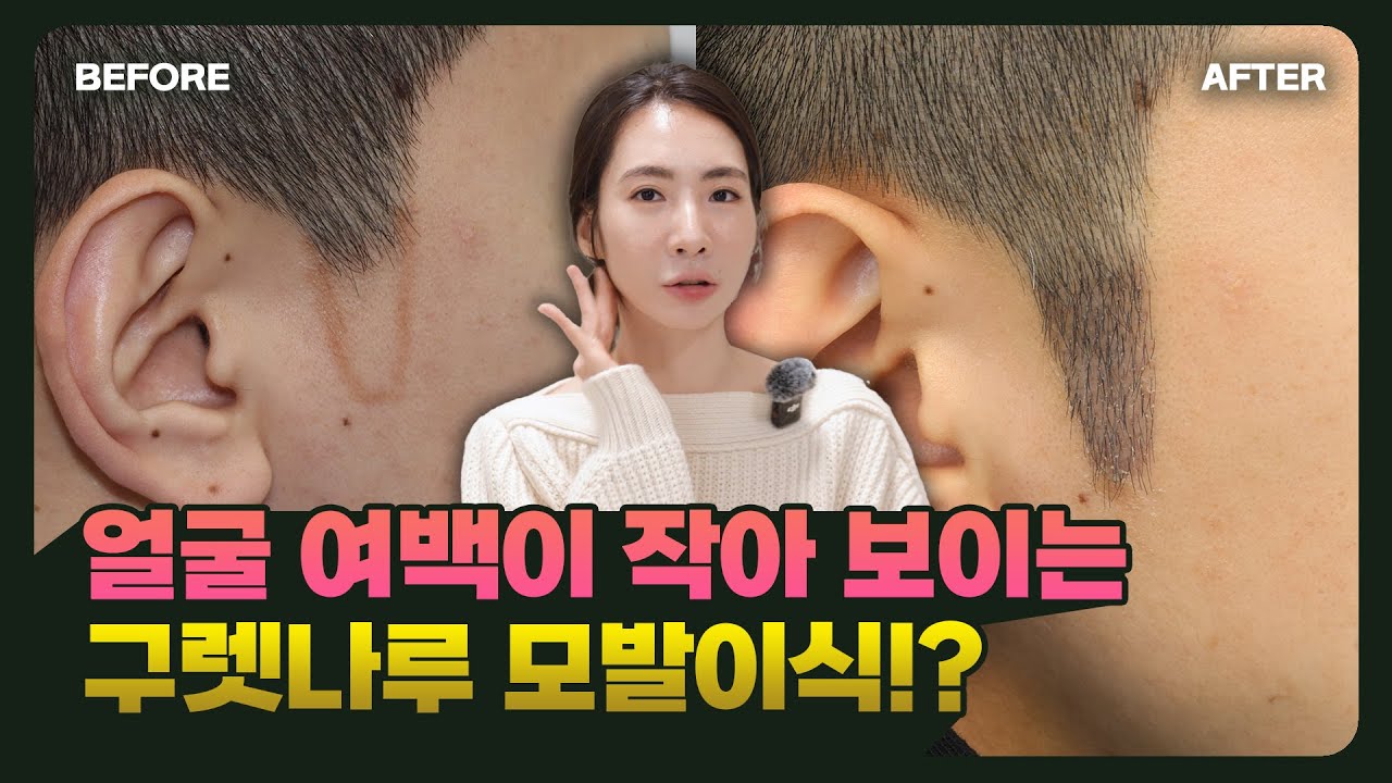 구레나룻 이식, 이런 분들에게 추천드립니다