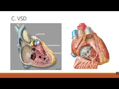 Truncus arteriosus - Dr Ahmed Osman