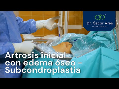 Artrosis inicial con edema óseo - Tratamiento con subcondroplastia - Dr. Oscar Ares