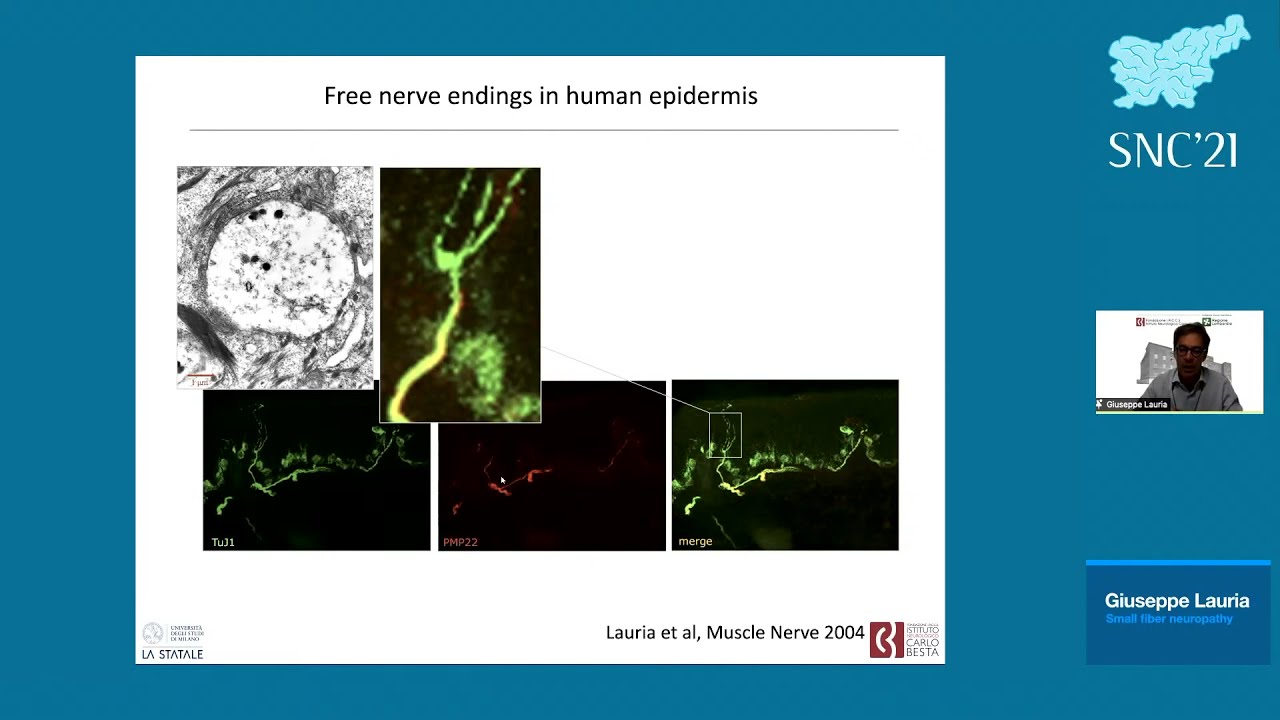 Giuseppe Lauria: Small fiber neuropathy