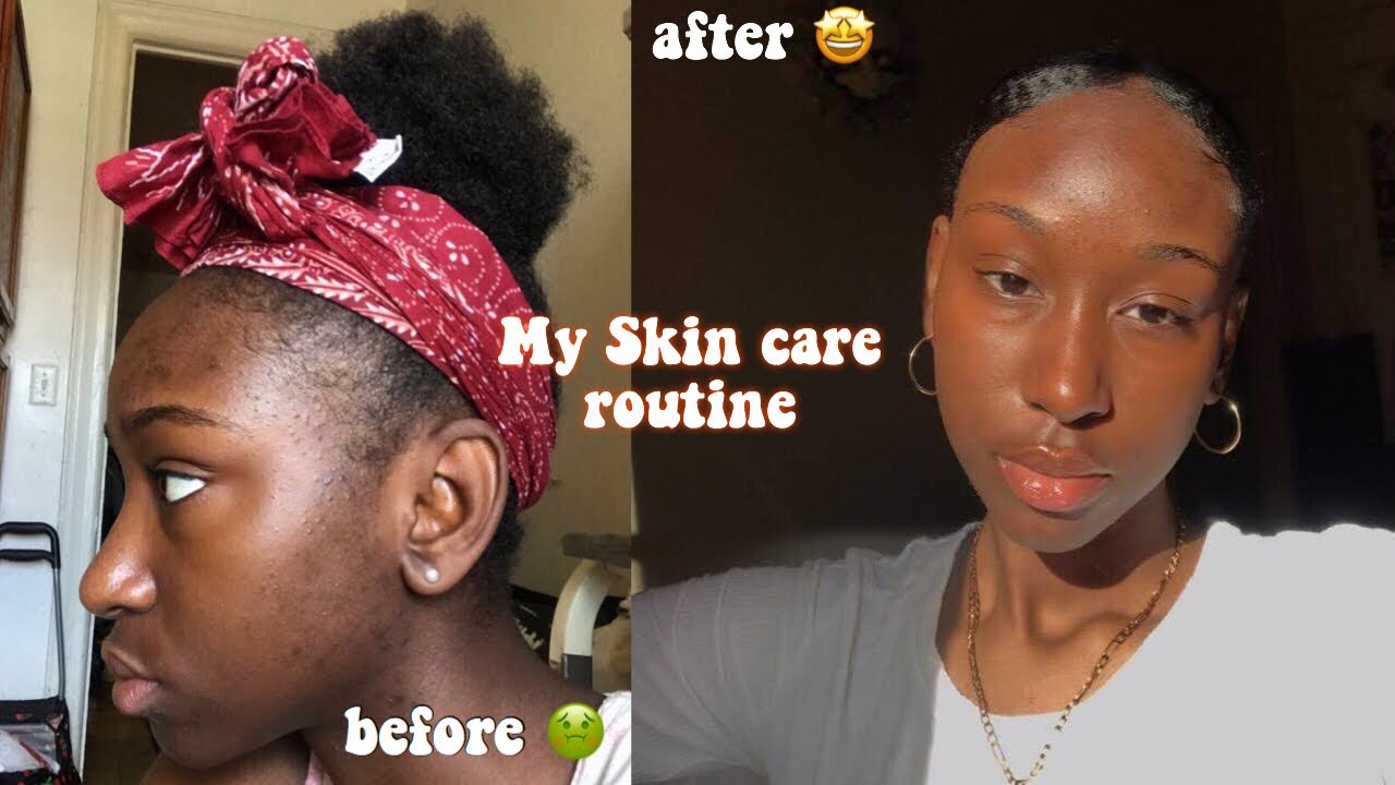 HOW TO CLEAR YOUR SKIN IN A WEEK! - YouTube