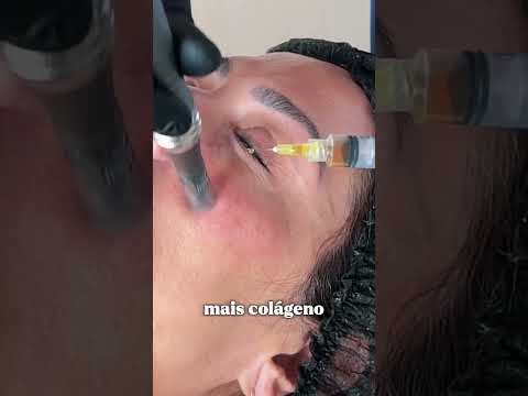 Microagulhamento com drug delivery: como funciona? — vídeo do Dr. Thiago Perfeito