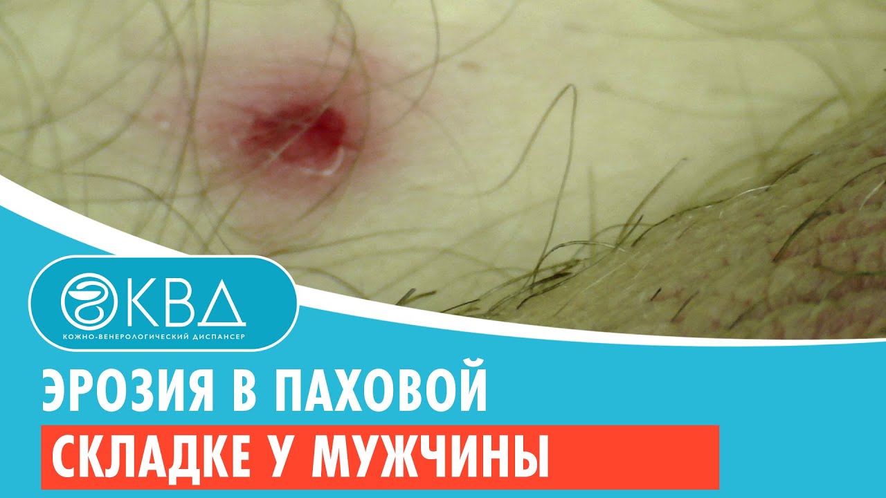 Где находится паховая вена у мужчин фото