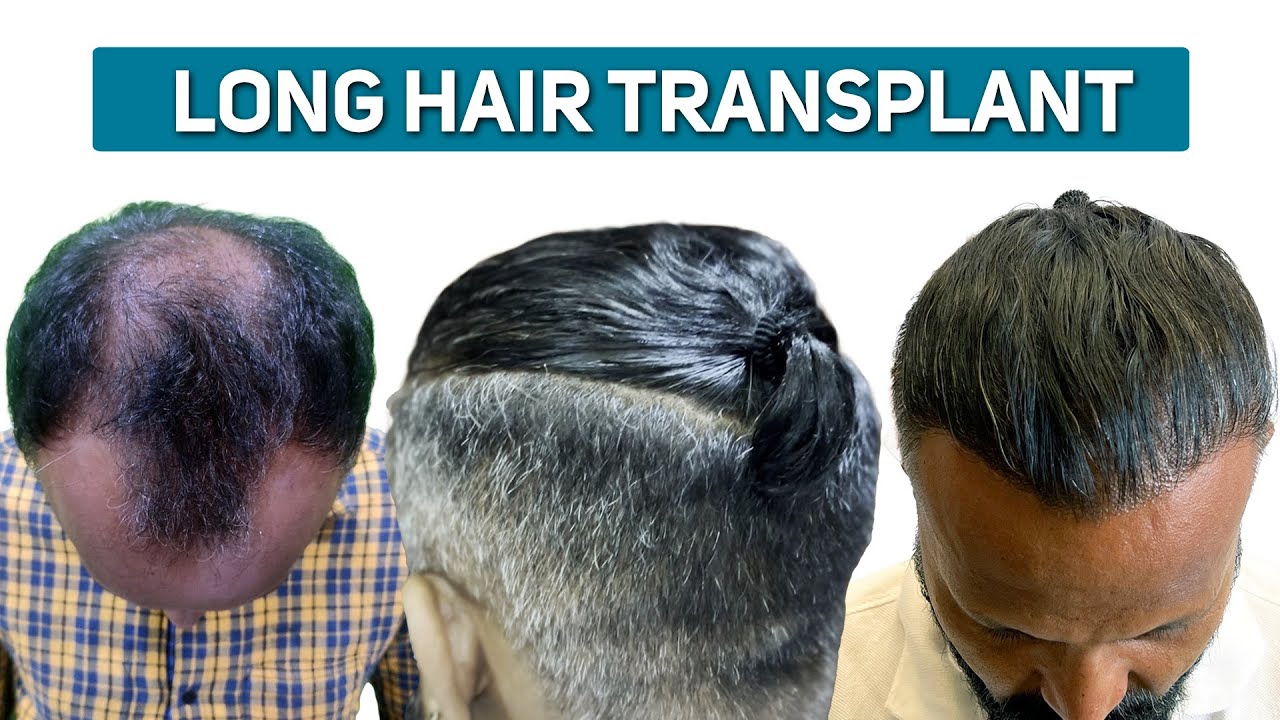 Long Hair Transplant