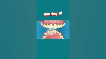 [3D]BỌC RĂNG SỨ | Nha Khoa Quốc Tế Athena