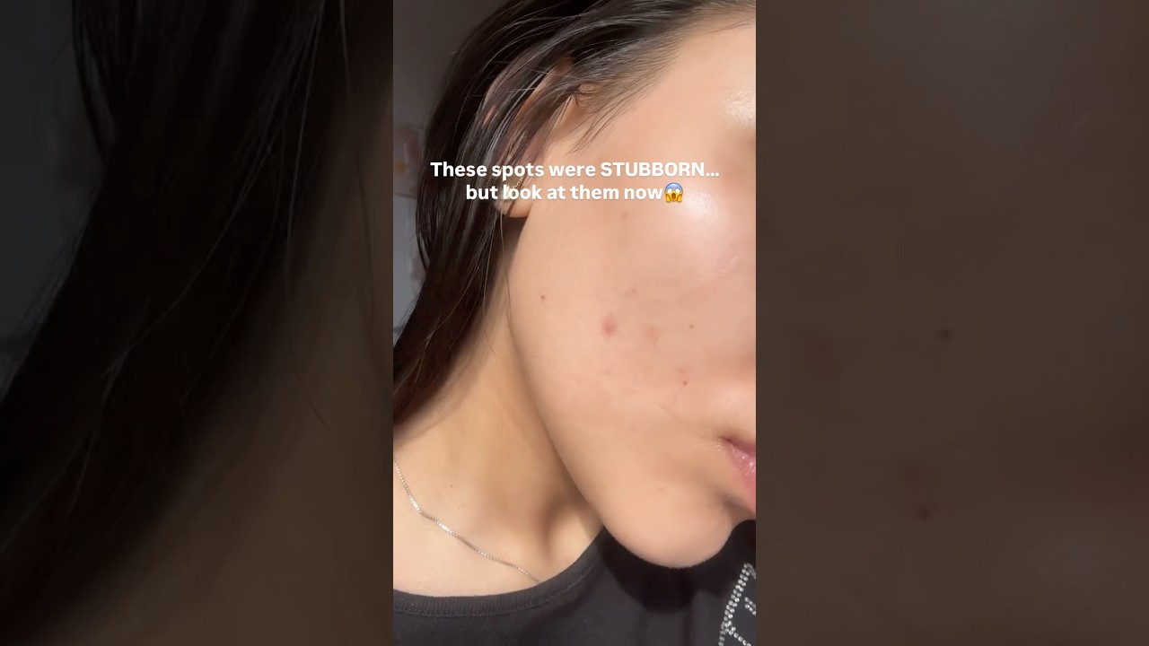 🌟 DARK SPOT TRANSFORMATION 🌟