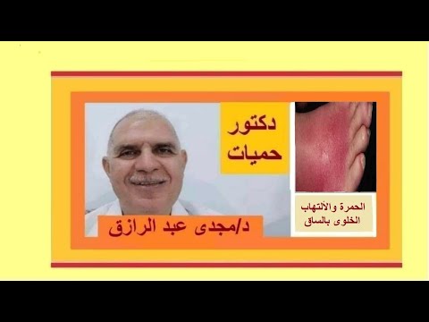 علاج الحمرة والألتهاب الخلوى بالساق Treatment Of Erysipelas And Cellulitis Of The Leg 