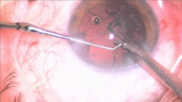 Zeiss 404V +33D Mishev Live Stream