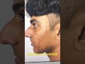 Amazing Nose Correction Plastic Surgery by Dr sunil richardson - Before and After 2 months