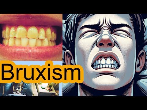 Teeth Grinding in Kids (Bruxism)