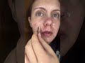 Part 51 #pimplepatchremoval #satisfying #asmr #pimples #acne