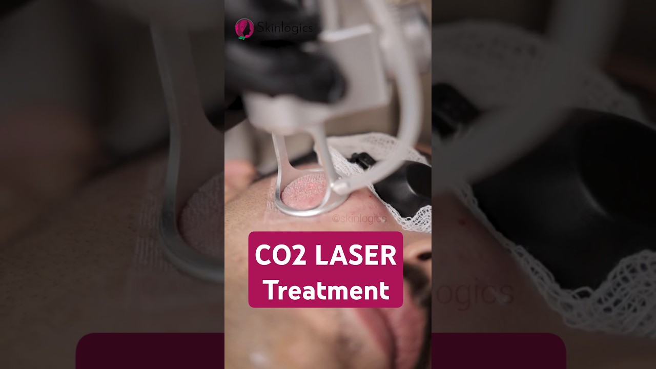 Erase Ice Pick & Boxcar Scars with CO2 Laser Treatment    