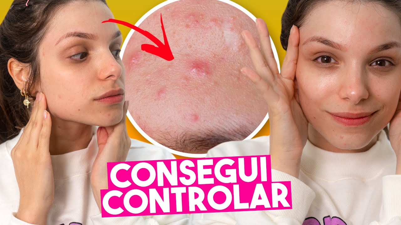 O que tem SALVADO MINHA PELE das ESPINHAS!! *Minha PELE sem ANTICONCEPCIONAL*