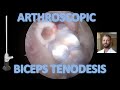 Arthroscopic biceps tenodesis  johnny t nelson md  raleigh upper ex