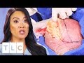 Dr. Lee Removes The Messiest Lipoma Ever! | Dr. Pimple Popper