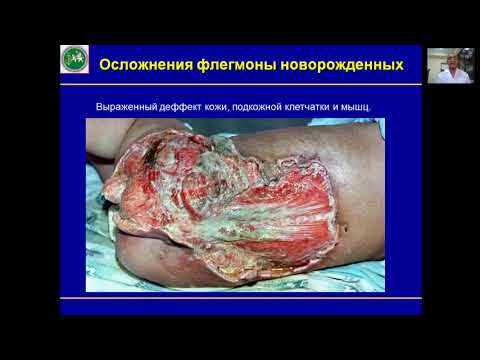 Гнойно воспалительные заболевания кожи и подкожной клетчатки у детей часть 1