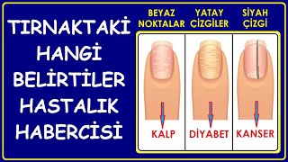 TIRNAKLARDAN HASTALIK TEŞHİSİ NASIL YAPILIYOR? HANGİ İŞARET HASTALIK BELİRTİSİ? Resimi