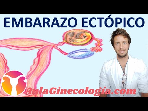 Video: ¿Se puede diagnosticar mal un embarazo ectópico?