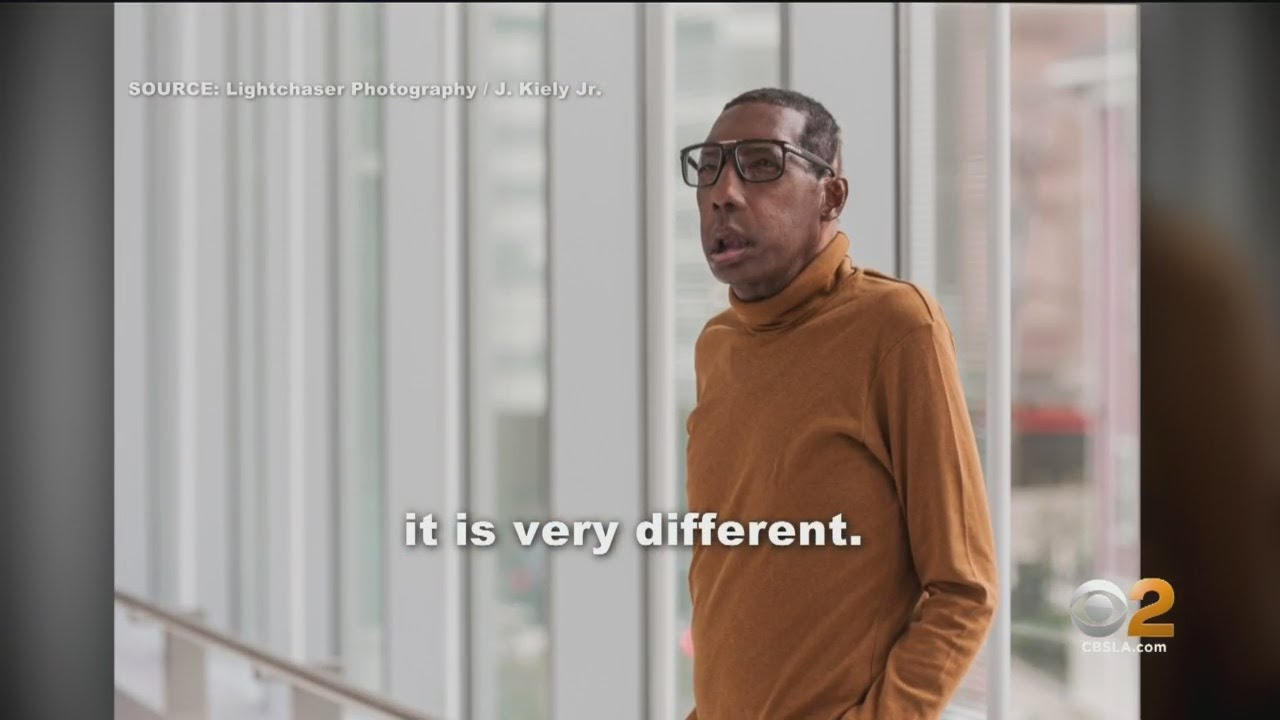 Paramount Man Talks About Historic Face Transplant After Being Hit By Drunk Driver