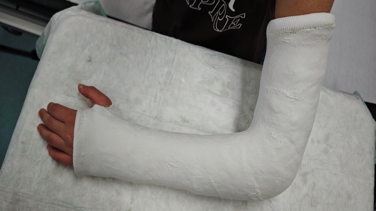 Come si applica un gesso brachio-metacarpale | Tecnica ortopedica didattica