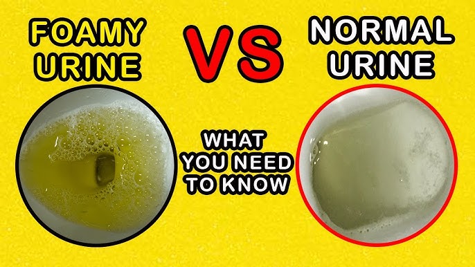 Bubbles In Urine bubbles-in-urine