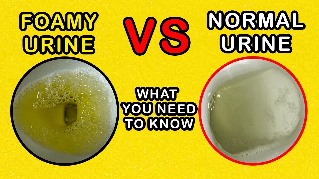 Foamy Urine Vs Normal Urine What Is The Difference And Causes Youtube